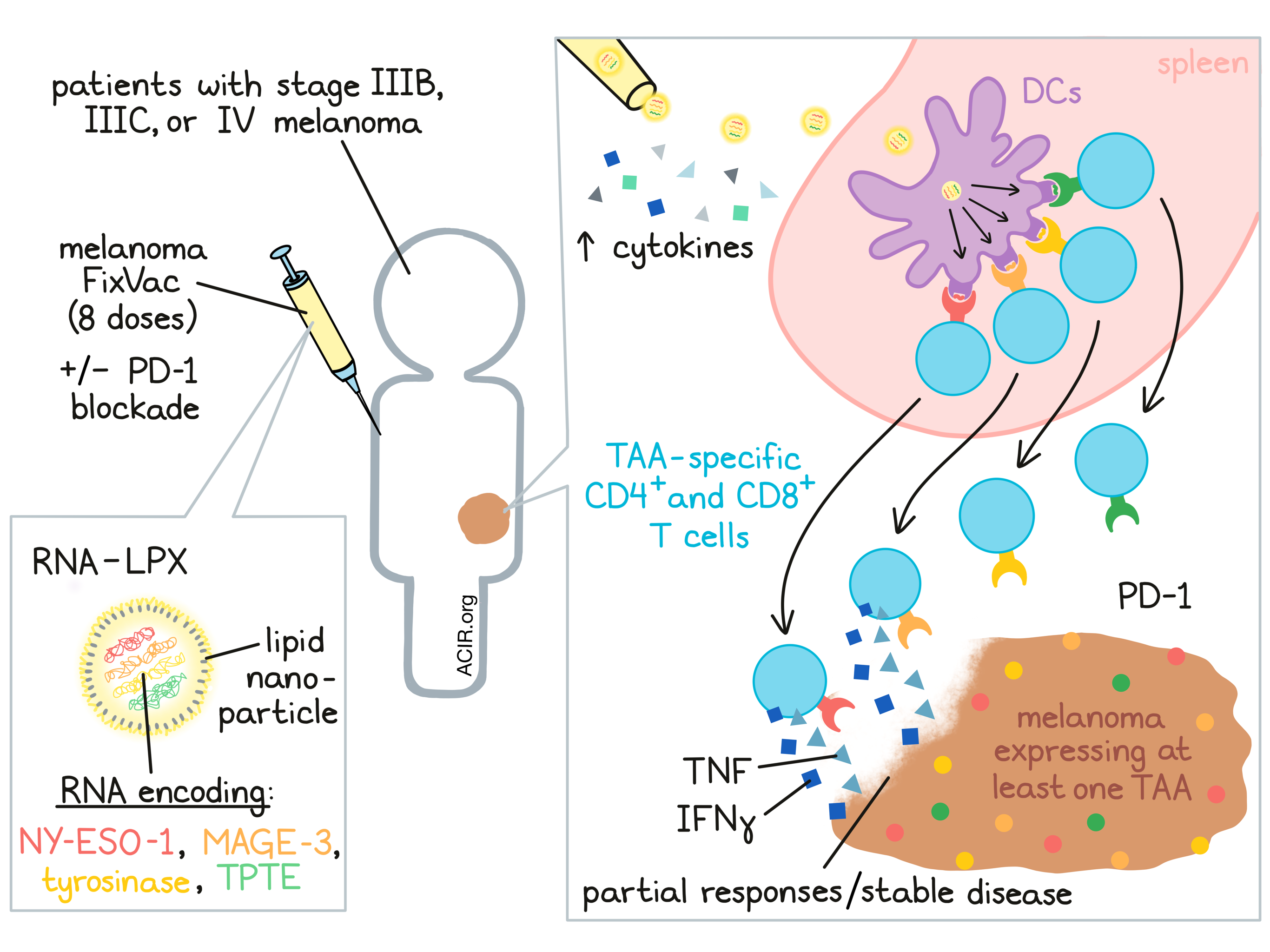 RNA vaccine for melanoma shows promise in early clinical trial